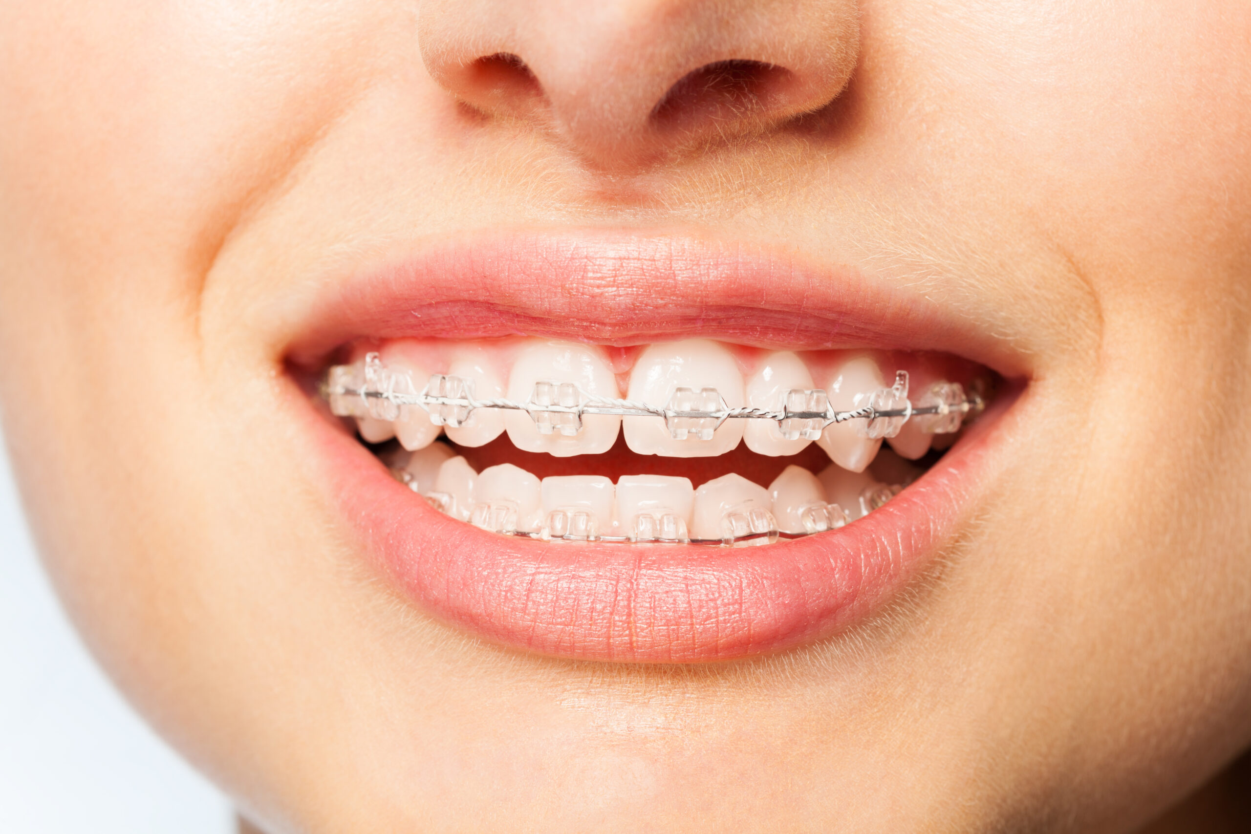 Healthy,Smile,Woman,With,Clear,Brackets Healthy,Smile,Woman,With,Clear,Brackets